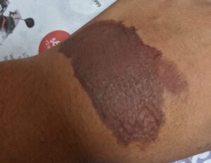 Alumno quema con supuesto nitrógeno líquido a compañeros