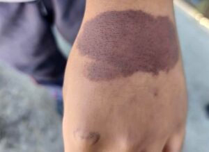 Alumno quema con supuesto nitrógeno líquido a compañeros