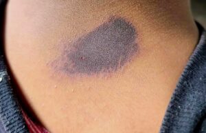 Alumno quema con supuesto nitrógeno líquido a compañeros